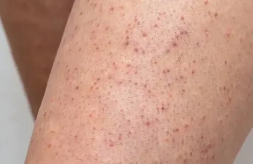 keratosis pilaris service image