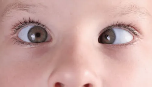 Squint Clinic service image