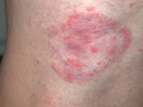 fungal infection service image