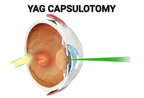 YAG Capsulotomy Treatment service image