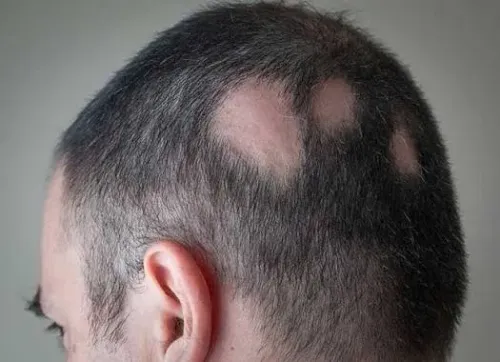 Alopecia Areata service image