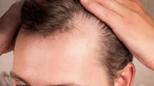 Androgenetic Alopecia service image