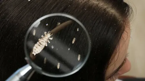 Head lice removal service image