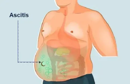 Ascites Treatment/Tapping Doctor in Baner, Balewadi, Pune service image