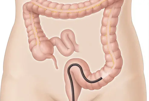 Sigmoidoscopy Treatment Doctor in Baner, Balewadi, Pune service image