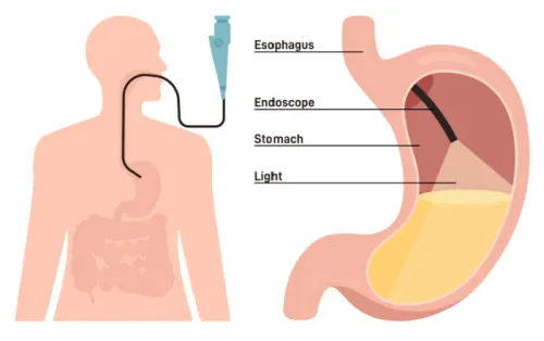 Upper GI Endoscopy Doctor in Baner, Balewadi, Pune service image