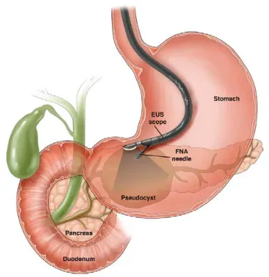 Therapeutic Endoscopist in Baner, Balewadi, Pune service image