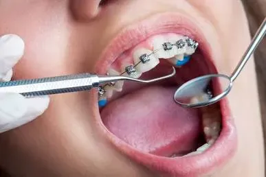 Fixed Ortho Treatment(Braces) service image