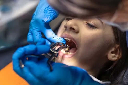 Wisdom Tooth Removal Treatment & Tooth Extractions service image