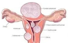 Fibroids & PCOD service image