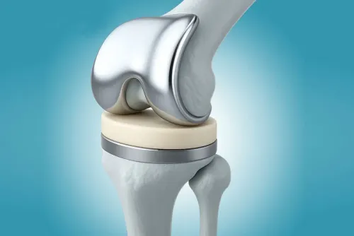 Joint Replacement service image