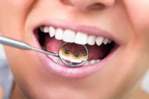 Lingual Braces Treatment service image