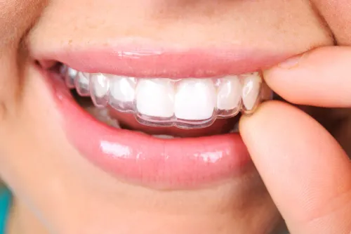Retainers Treatment service image