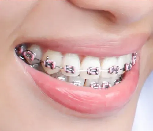 Braces Metal Treatment service image
