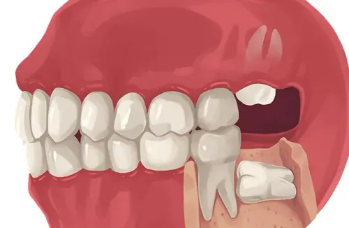 Wisdom Tooth Extraction service image