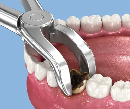 Extraction Treatment service image