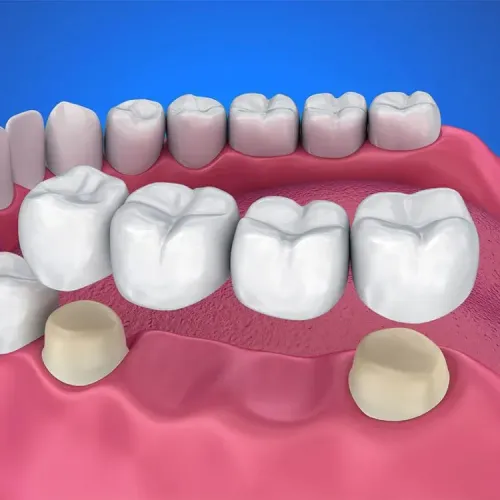 Crown and Bridge Treatment service image