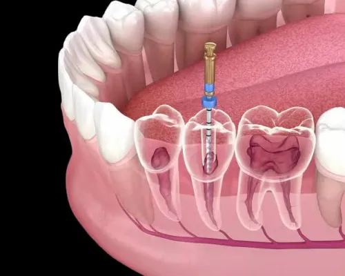 Root Canal Treatment service image