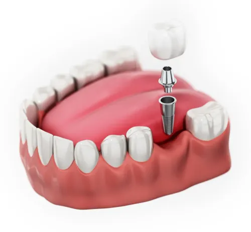 Single Tooth Implant service image