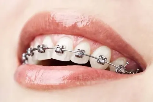 Fixed Ortho(Braces) service image