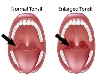 Tonsillectomy service image