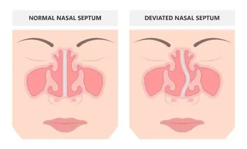 Deviated Septum Surgeries service image