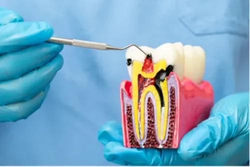 Root Canal Treatment service image