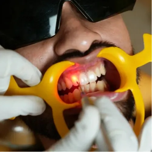 Advanced Laser Dentistry service image