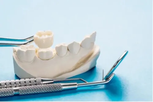 Dental Crowns (Teeth Caps) service image