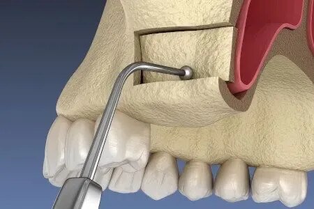 Sinus lift surgery direct and indirect both  service image