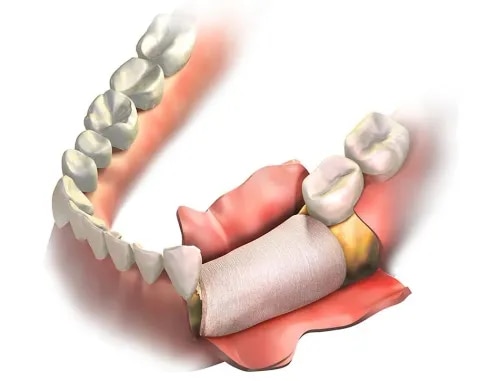 Bone grafting and Guided Bone  service image