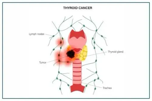 Thyroid Cancer service image