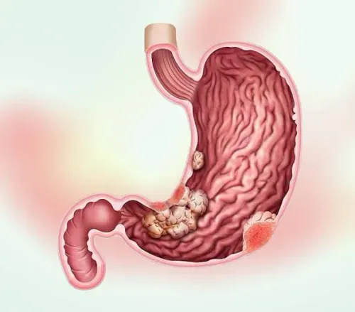 Gastrointestinal Cancer service image
