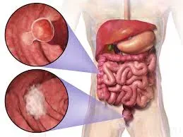 Colon Cancer service image