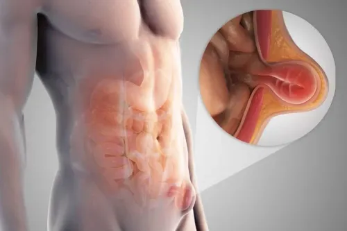Hernia Surgeries service image