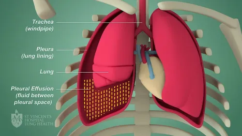 Pleural Disease Treatment – Dr. Sanjay Gabhale service image
