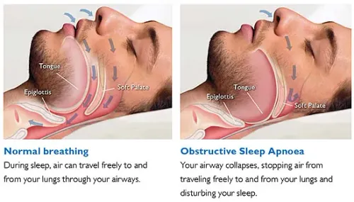 Sleep-Disordered Breathing service image
