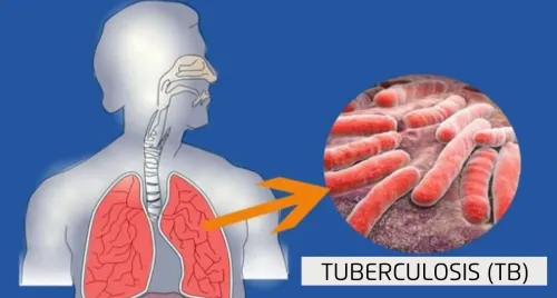 Tuberculosis (TB) Treatment – Dr. Sanjay Gabhale, Chest Clinic Moshi service image