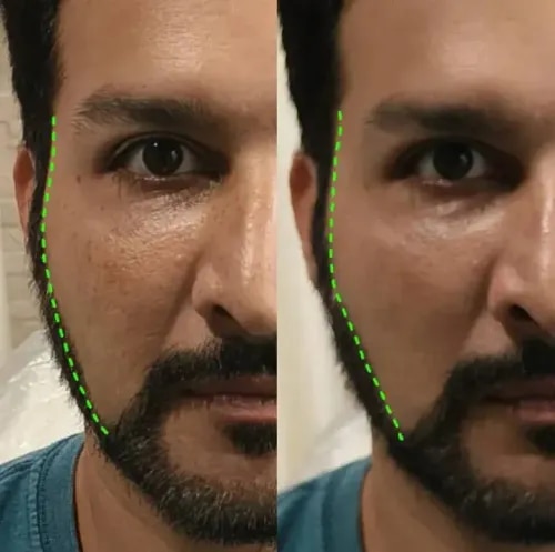 Cheek Filler service image