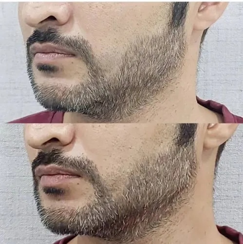 Chin and Jawline Filler  service image