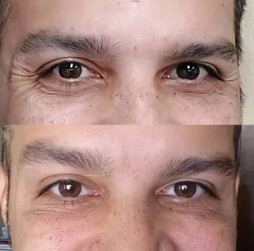 Botox Treatment  service image