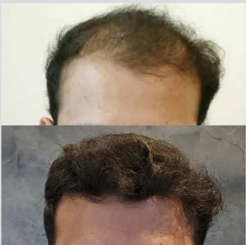 Non Surgical Hair Restoration / Hair Regrowth Without Hair Transplant  service image