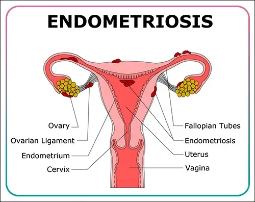 Endometriosis Treatment Specialist in Ambegaon, Narhe, Dhayari  service image