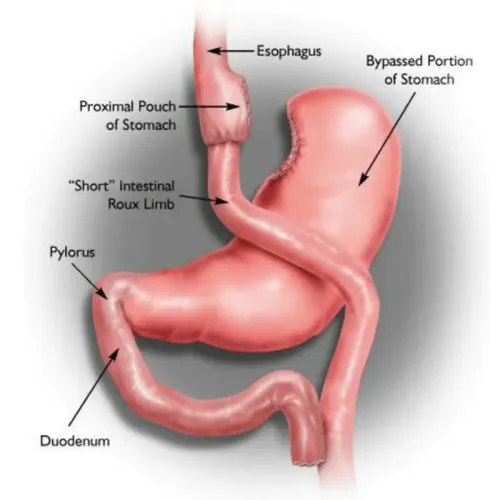 Gastric Bypass Surgery service image