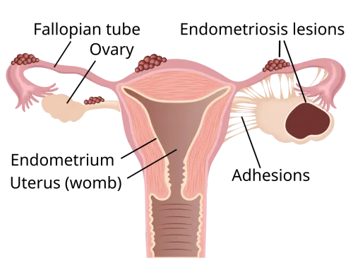 Endometriosis Treatment service image