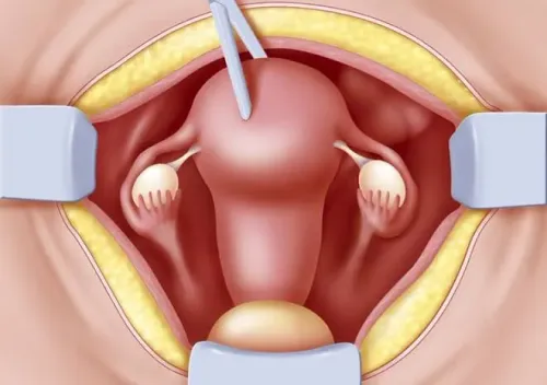 Uterus Removal Surgery service image