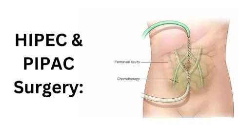 HIPEC/PIPAC procedures service image