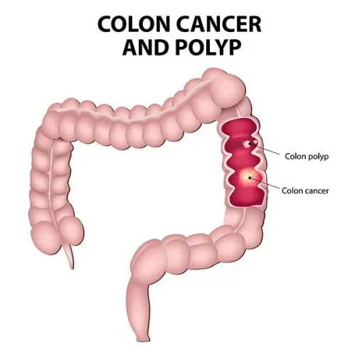 Colorectal cancer service image