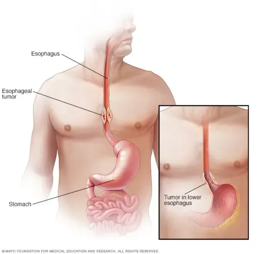 Esophageal cancer service image