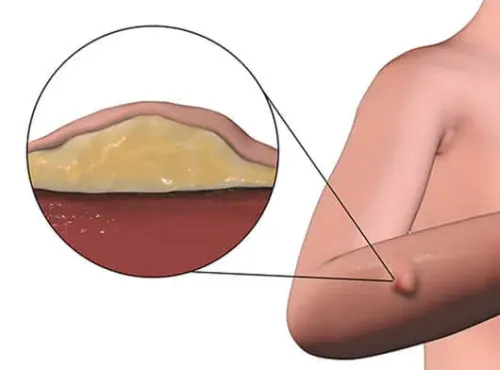 Soft tissue sarcomas service image